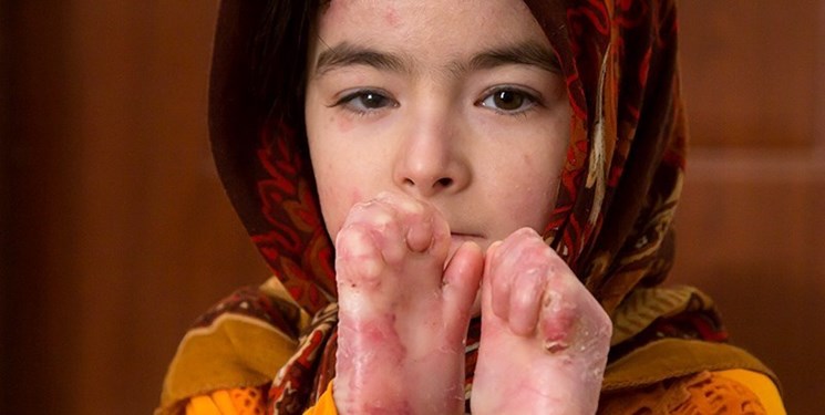 ساخت مسکن برای بیماران پروانه‌ای در گلستان
